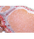 Nódulo radicular, s.t.