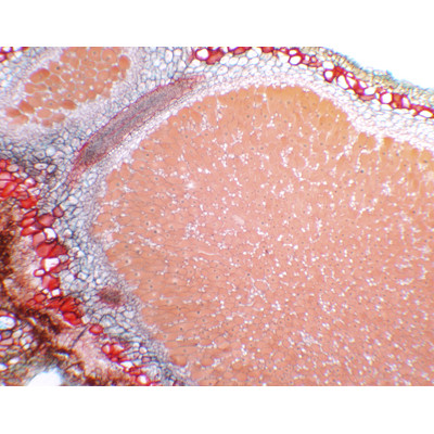 Nódulo radicular, s.t.