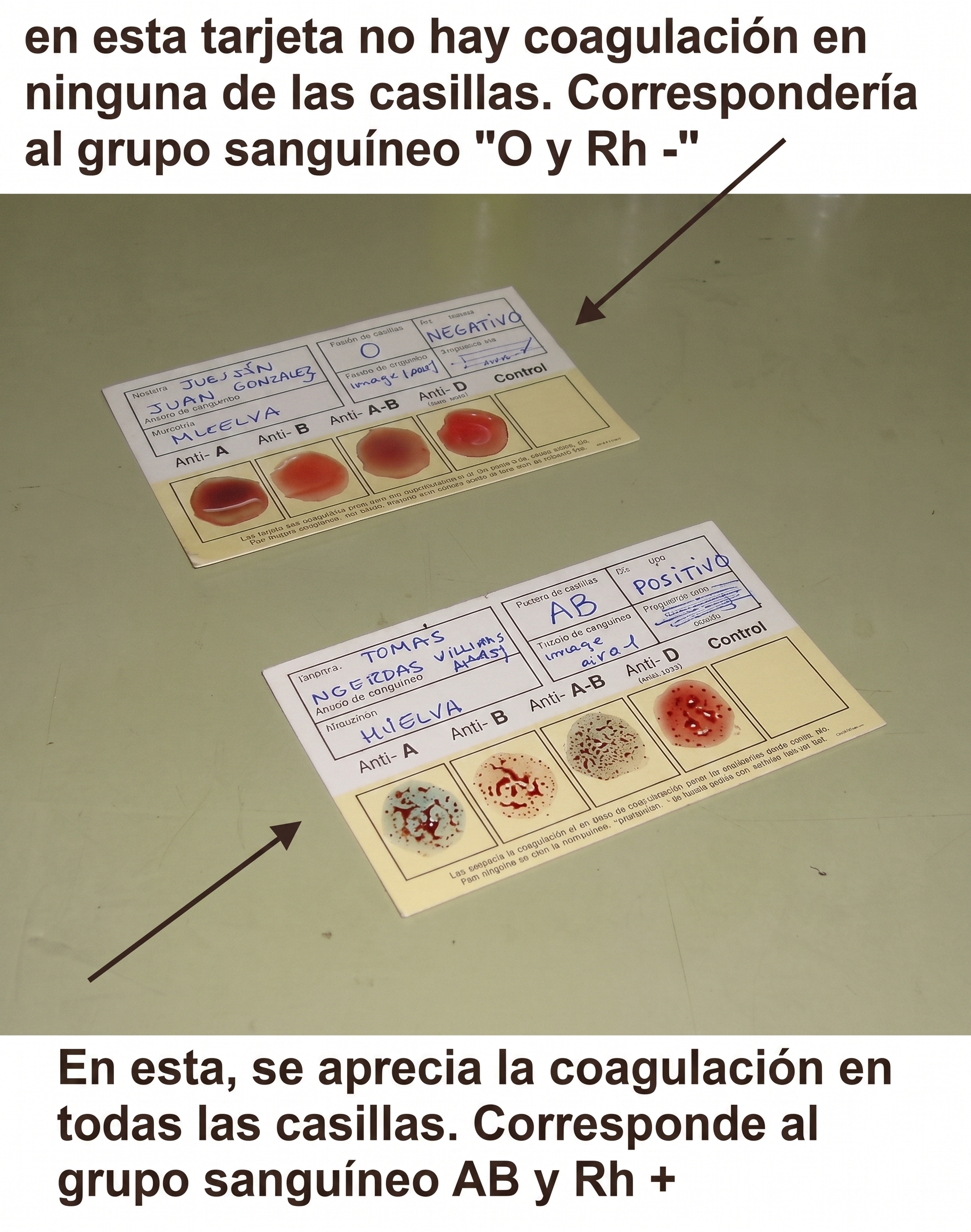 Ejemplos de tarjetas con resultados de grupo sanguíneo O negativo y AB positivo